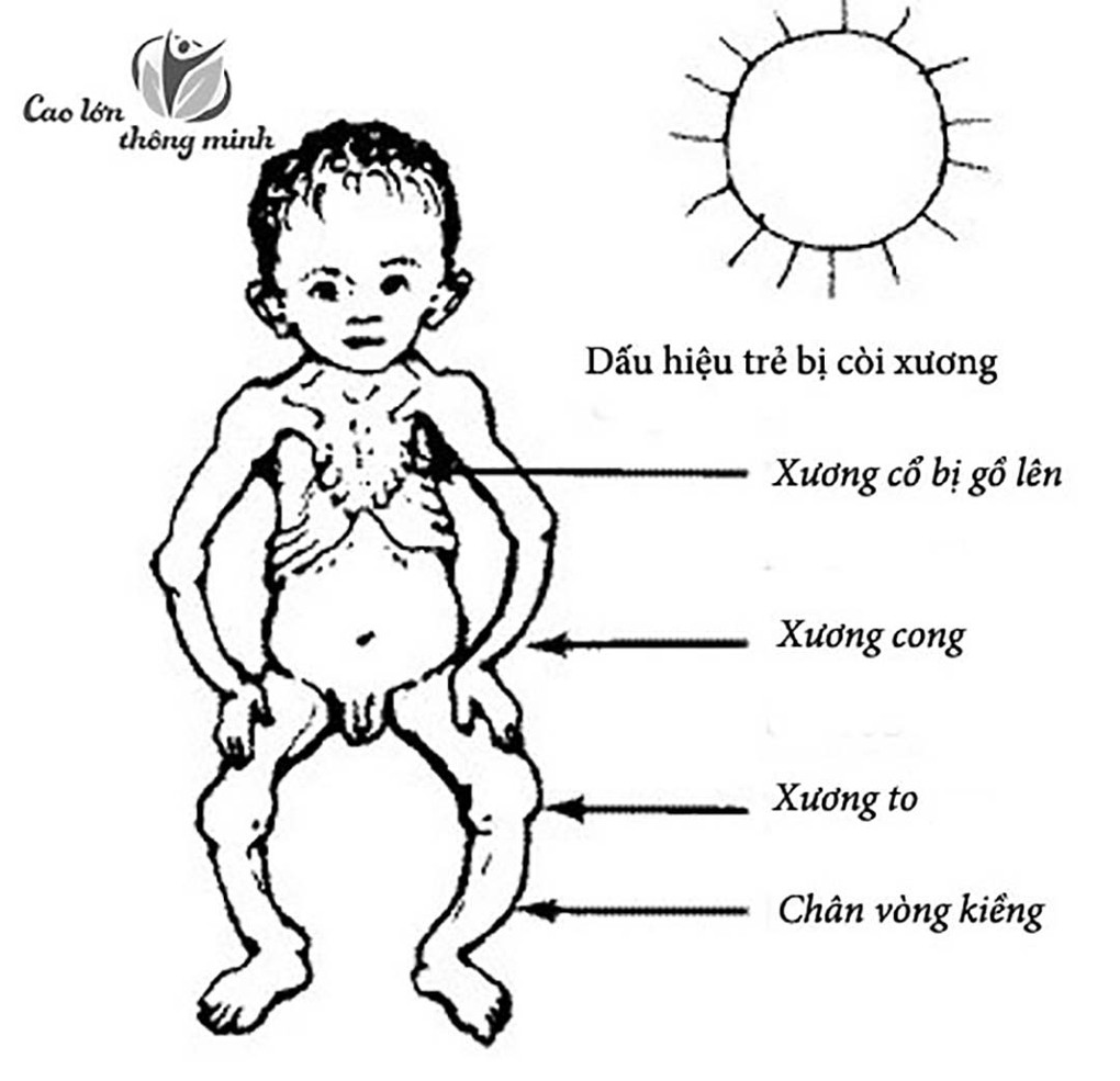 Còi xương ở trẻ em - bệnh không thể coi thường