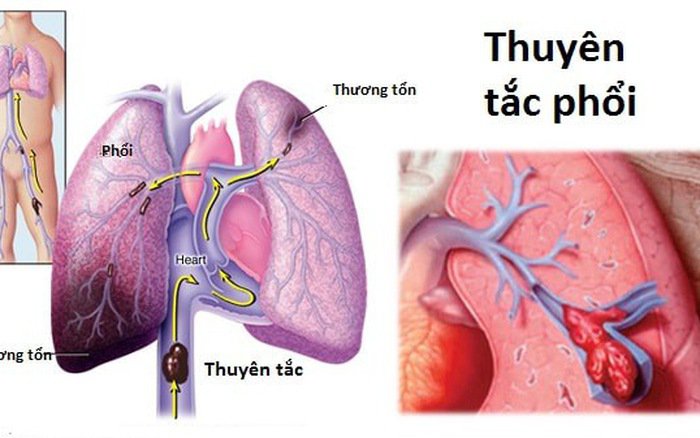cẩn thận thuyên tắc động mạch phổi hậu Covid