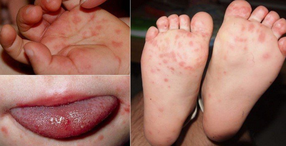 biến chứng nguy hiểm của bệnh tay chân miệng