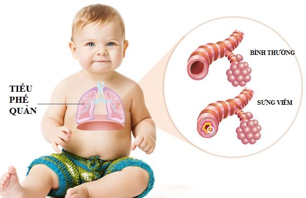 chắm sóc trẻ bị viêm tiểu phế quản