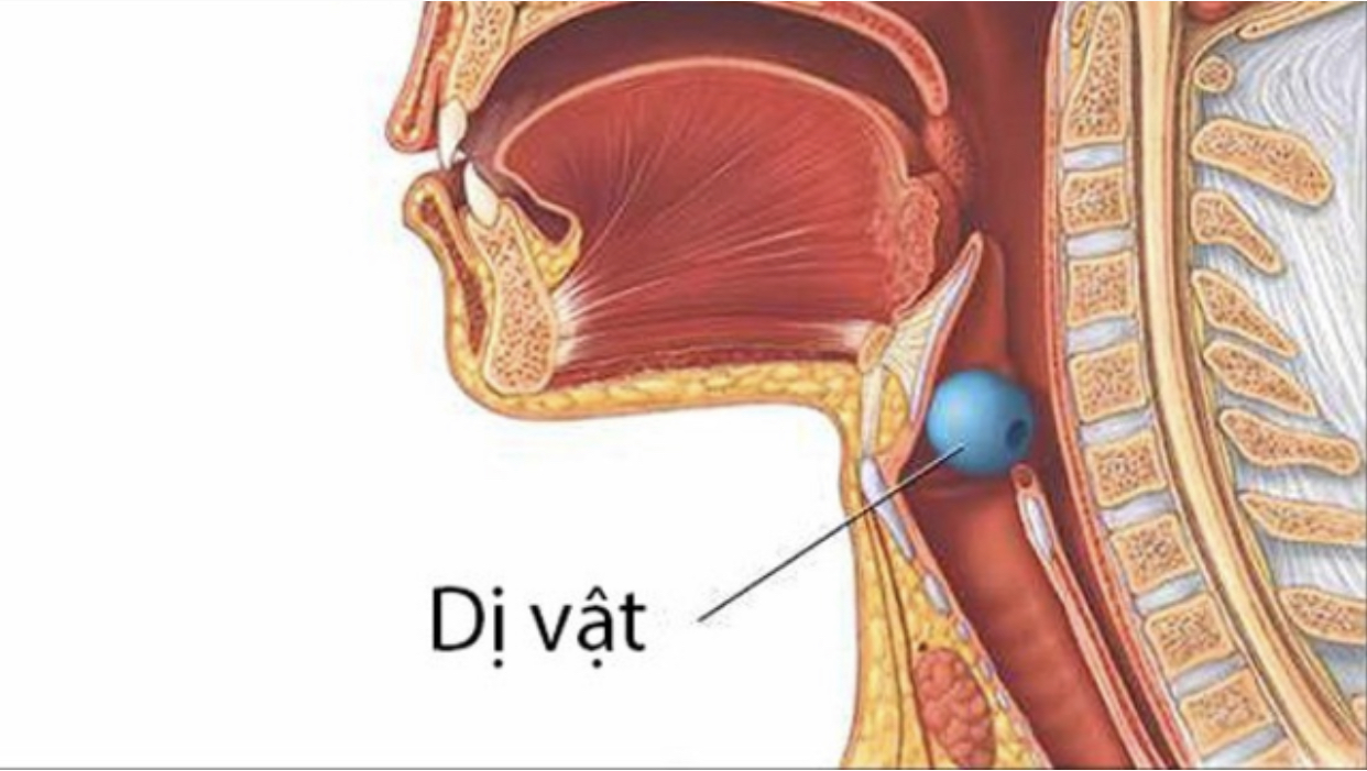 Cảnh báo trẻ nguy kịch do hóc dị vật mà không biết