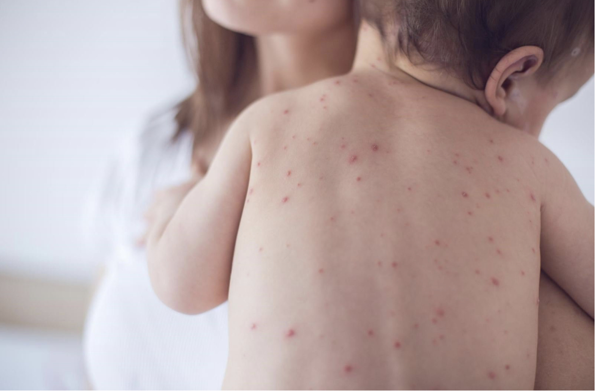Làm sao để phòng tránh bệnh đậu mùa cho trẻ?