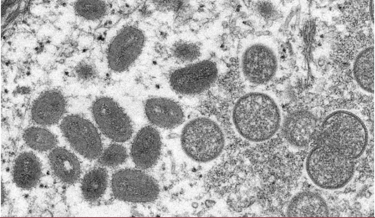 Nguy cơ virus đậu mùa khỉ đột biến