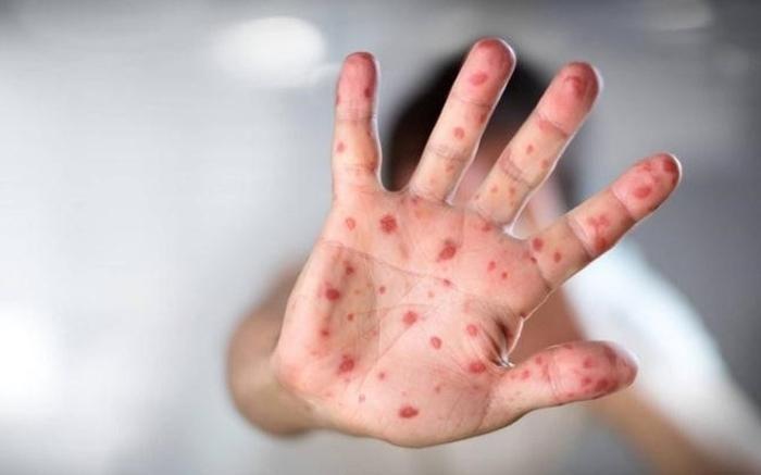9 cách chữa bỏng ớt ở tay, mắt, miệng nhanh chóng và an toàn