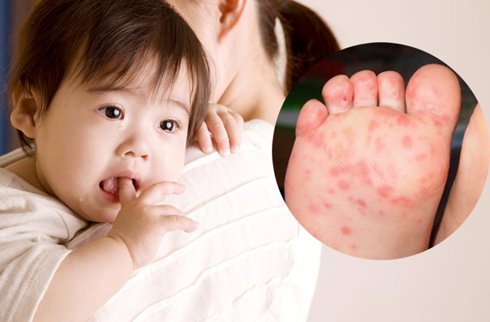 Trẻ có thể bị tay chân miệng và sốt xuất huyết cùng lúc không? Phân biệt vết loét do tay chân miệng gây ra
