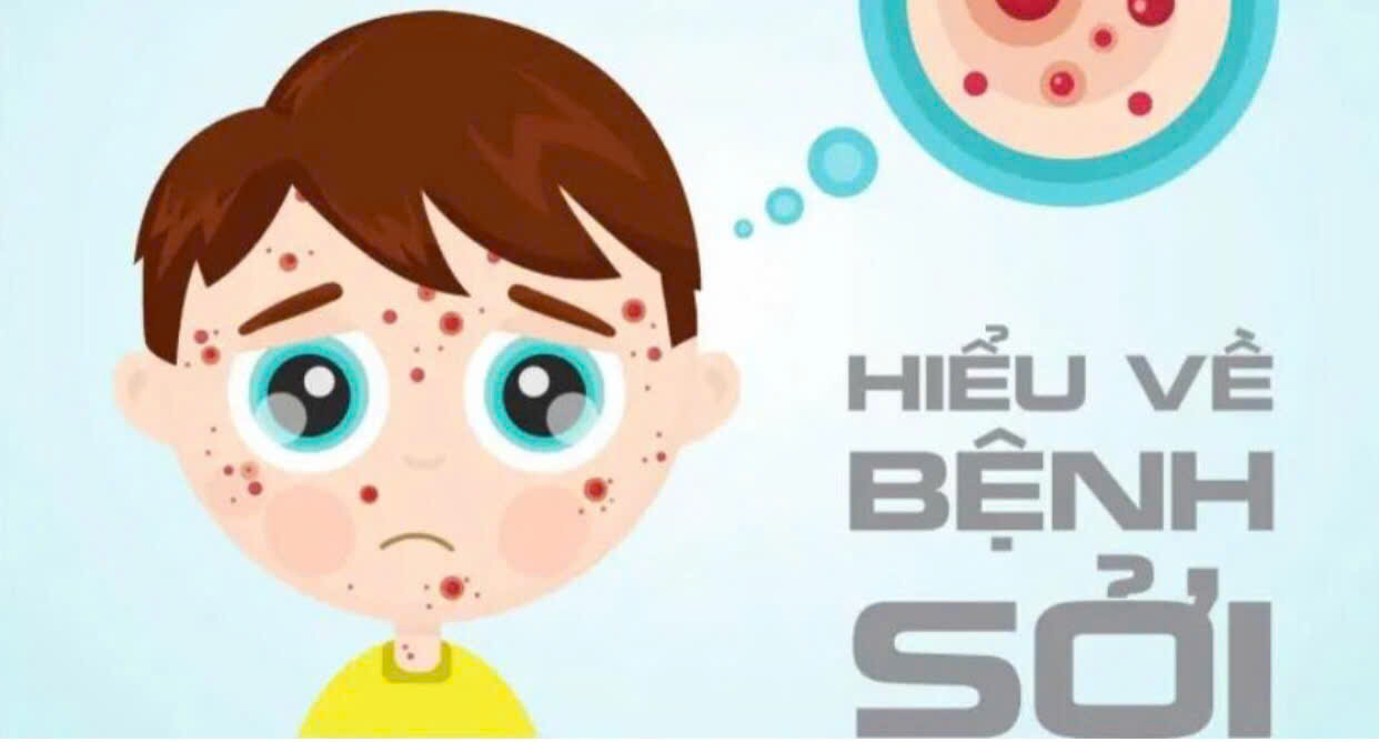 Những điều cần biết về bệnh sởi