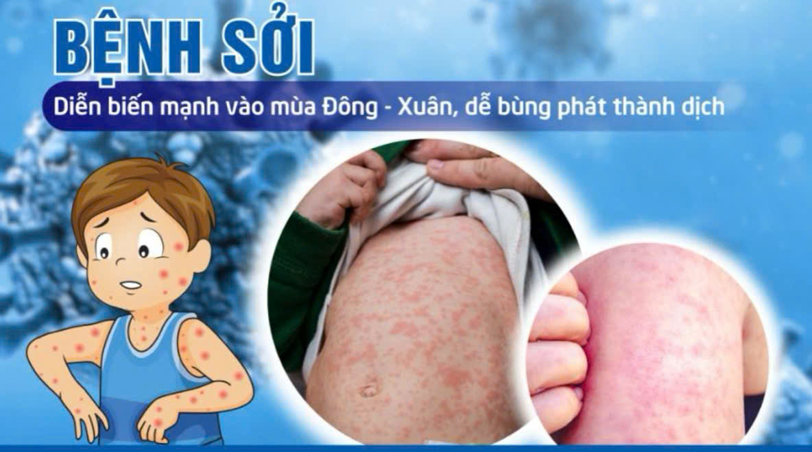 BỆNH SỞI: DẤU HIỆU, NGUYÊN NHÂN, CHẨN ĐOÁN VÀ CÁCH PHÒNG NGỪA