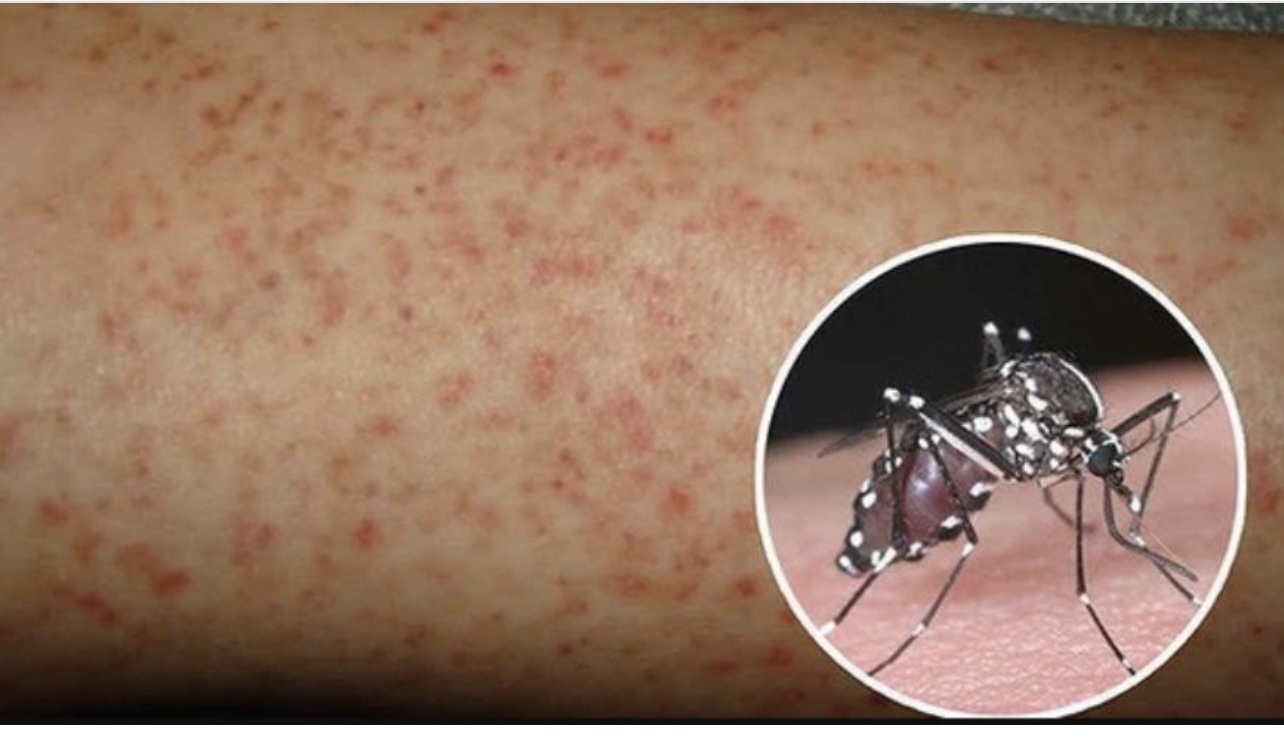 9 cách phòng bệnh sốt xuất huyết có thể áp dụng tại nhà.