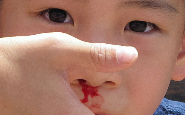Chảy máu cam ở trẻ gia tăng khi thời tiết hanh khô và cách xử trí - Ảnh 2.